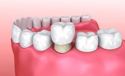 dental crown in arcadia