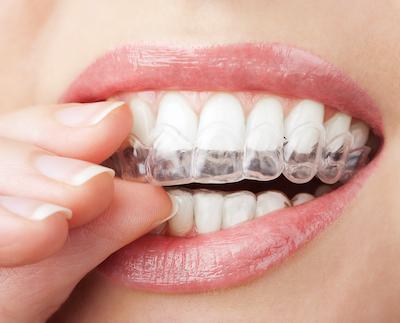 Close up of woman using clear aligners 