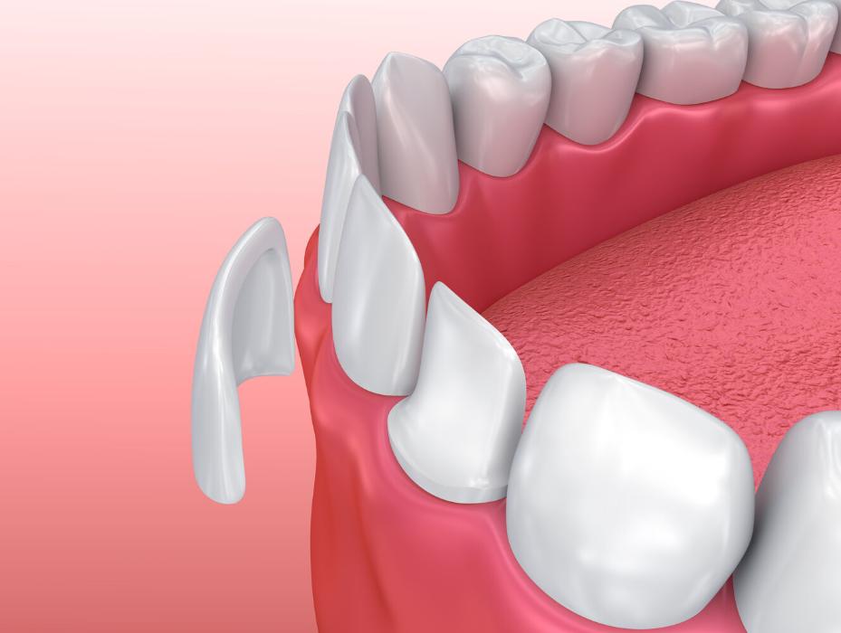 dental veneers in phoenix