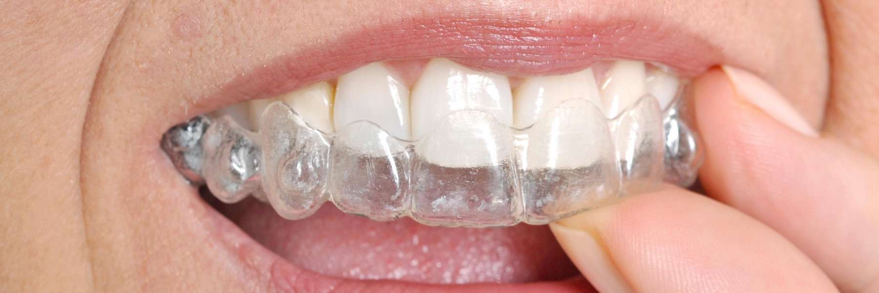 clear Invisalign aligners for a confident, beautiful smile 