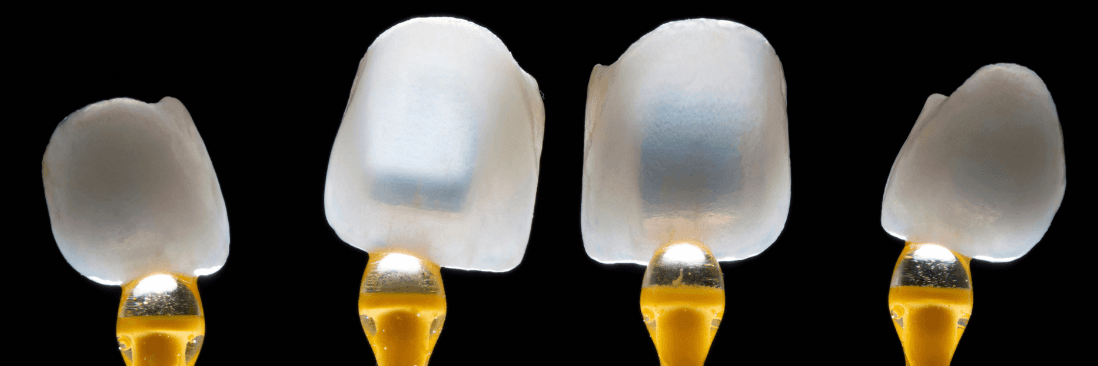Close-up of porcelain dental veneers in Phoenix