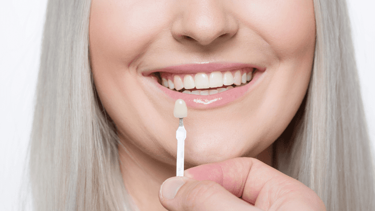 Woman smiling with dental veneer in Phoenix